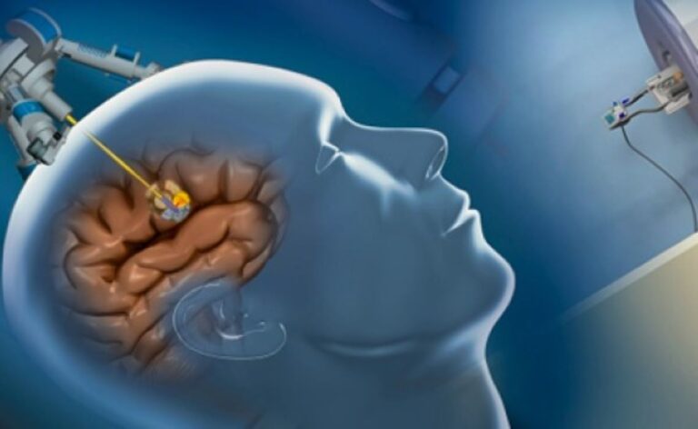 Livasa Hospital Mohali Crosses Milestone With 500+ Neuronavigation Surgeries